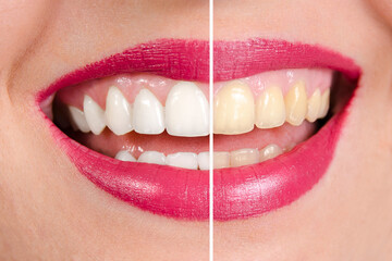 Teeth Whitening strips.